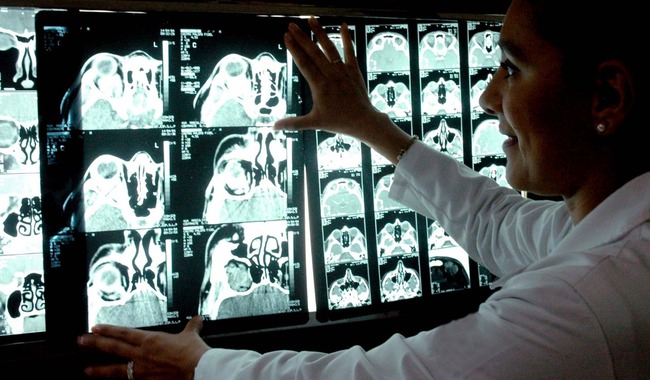 México capacita a miles para combatir el Ictus (Derrame cerebral): ¡Conoce los síntomas y salva vidas!